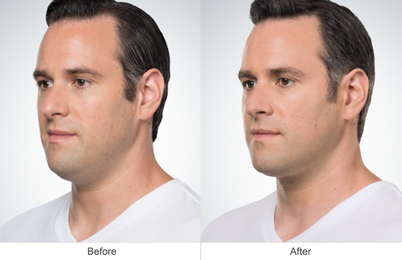 Before and after Kybella treatment on a man