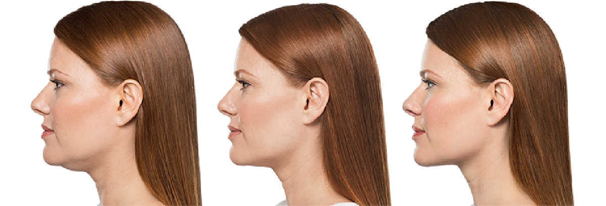 Treatment results from Kybella treatments